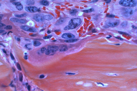 Descubrimientos Recientes en la Detección del Cáncer de Colon